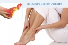 Ոտքերում այրոցի զգացում