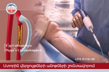 Ստորին վերջույթների անոթների շունտավորում